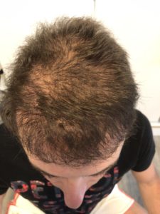 Nach der Haartransplantation von oben
