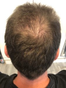 Nach der Haartransplantation