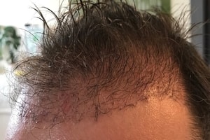 12 Wochen nach der Haarverpflanzung