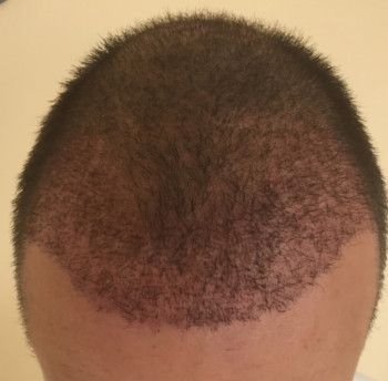 3 Wochen nach der Haartransplantation