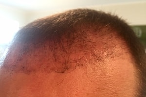 Haarverpflanzung Türkei Erfahrungen - 6 Wochen