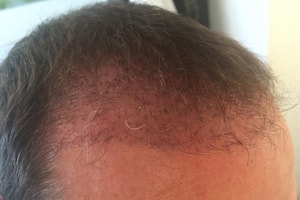 Haartransplantation Vorher Nachher 10 Wochen