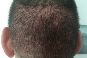 Haartransplantation Türkei Vorher Nachher 26 Tage