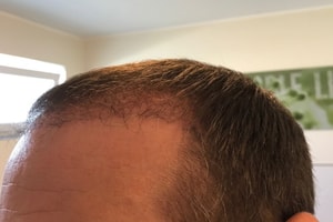 Haartransplantation Vorher Nachher 11 Wochen