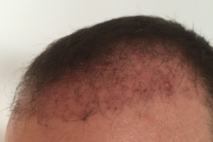 2 Monate nach der Haartransplantation