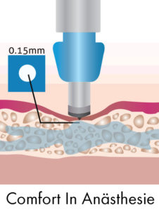 Haartransplantation Betäubung ohne Schmerzen