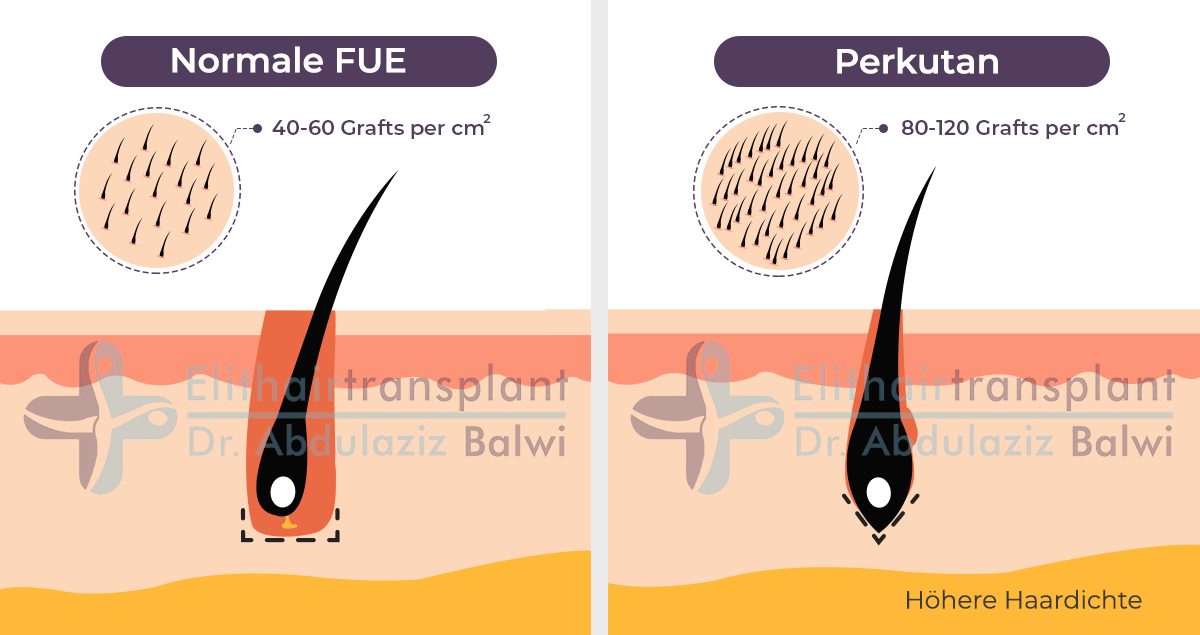 Haartransplantation Betäubung