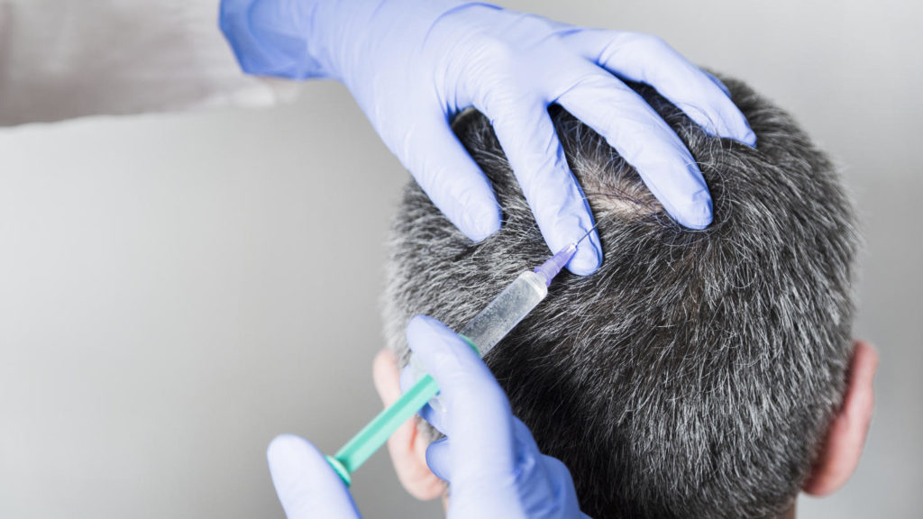 Was kostet eine PRP Behandlung in Berlin und warum ist sie so effektiv?